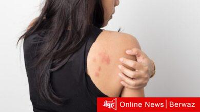 علامات على الجلد تدل على الإصابة بأوميكرون