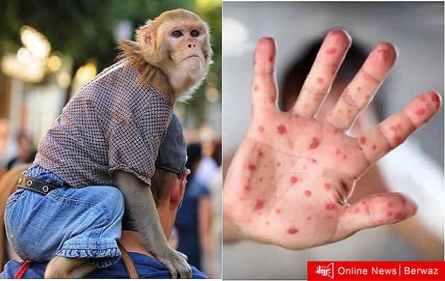 جدري القرود