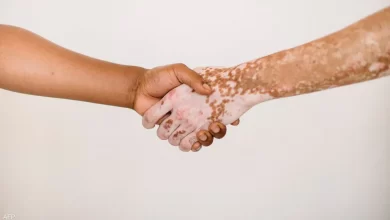 دواء للبهاق