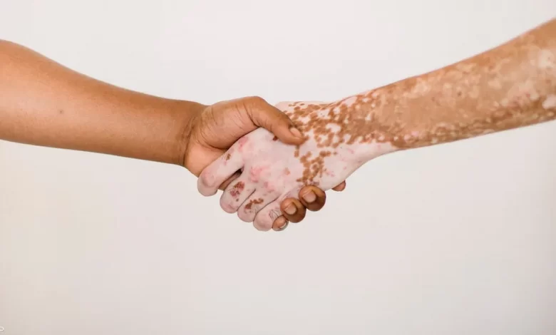 دواء للبهاق