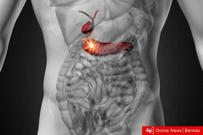 سرطان البنكرياس