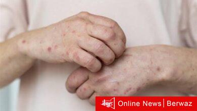 جدري القردة