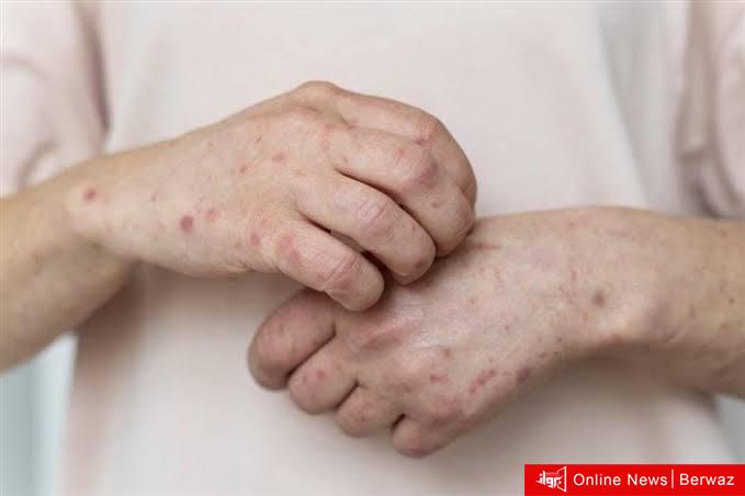 جدري القردة